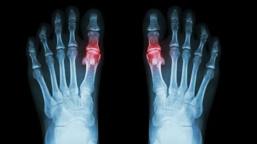 What you don't know about Gout or the Kings Disease