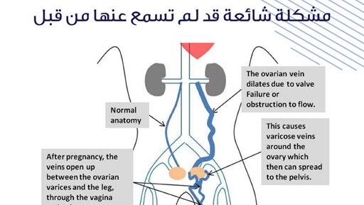 متلازمة احتقان الحوض: المشكلة الشائعة التي لم تسمع بها من قبل⁣⁣