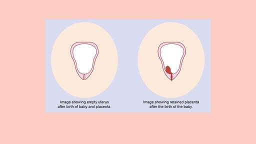 المشيمة المحتجزة أو الملتصقة ... تعريفها وأعراضها وعلاجها