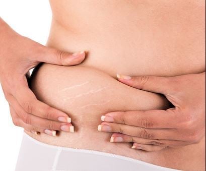 Believe it or not ... many men find stretch marks attractive!