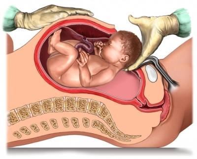 7 reasons why Cesarean Section is better than Natural Labor