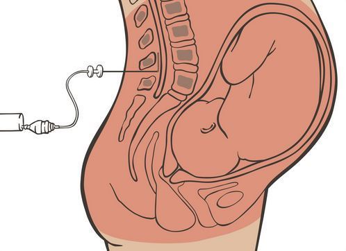 هل ابرة الظهر مؤلمة فعلا وقاتلة للألم في آن؟!