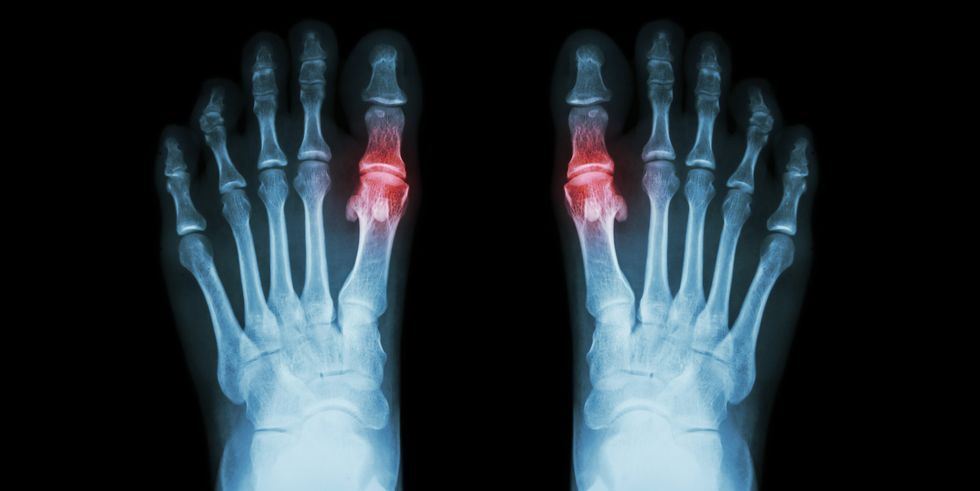 What you don't know about Gout or the Kings Disease