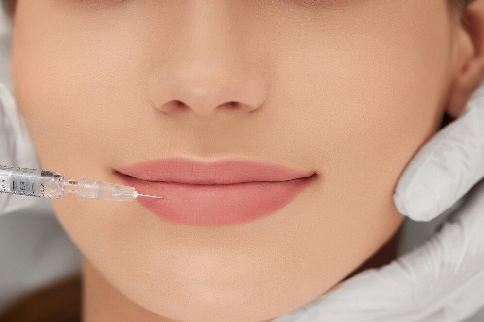 5 Important Tips to follow after getting Lip Fillers