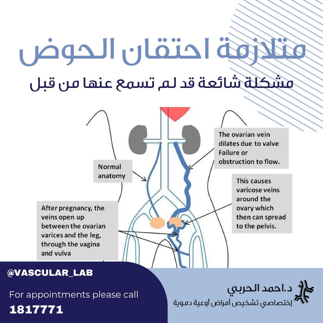 متلازمة احتقان الحوض: المشكلة الشائعة التي لم تسمع بها من قبل⁣⁣